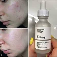 The Ordinary Niacinamide 10% + Zinc 1 %